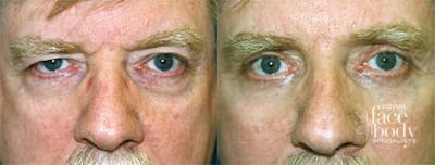 Eyelid Surgery Before & After Gallery - Patient 125434 - Image 1