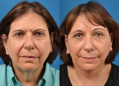 Facelift Before & After Gallery - Patient 122405941 - Image 1