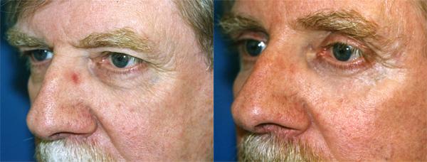 Eyelid Surgery Before & After Gallery - Patient 125434 - Image 2