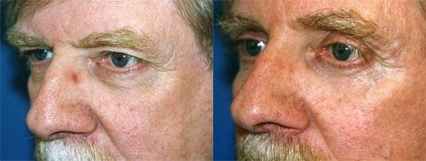 Eyelid Surgery Before & After Gallery - Patient 122405938 - Image 2