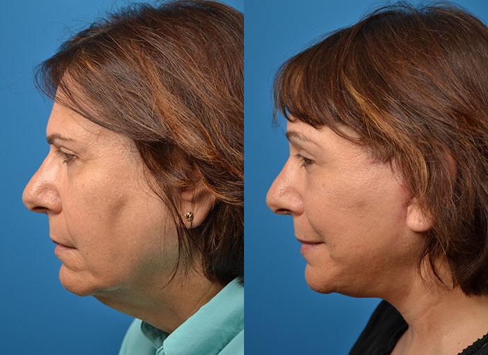 Facelift Before & After Gallery - Patient 122405941 - Image 2