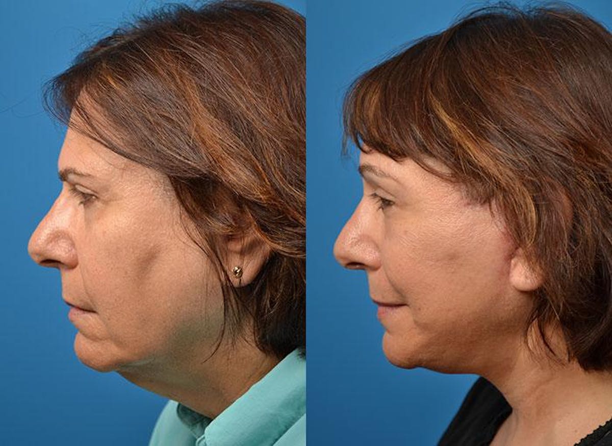 Facelift Before & After Gallery - Patient 122405941 - Image 2