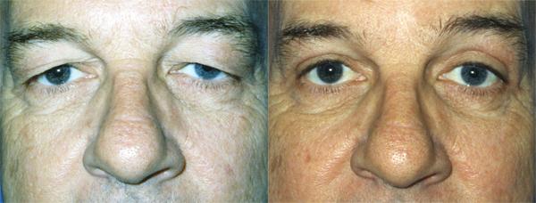 Eyelid Surgery Before & After Gallery - Patient 572720 - Image 1