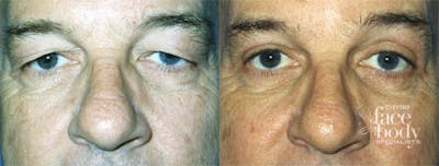 Eyelid Surgery Before & After Gallery - Patient 572720 - Image 1