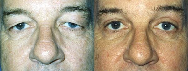 Eyelid Surgery Before & After Gallery - Patient 122405940 - Image 1