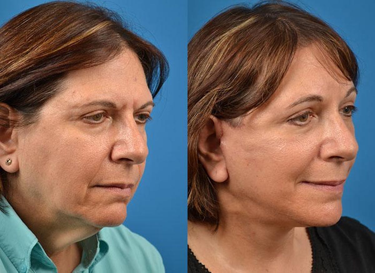 Facelift Before & After Gallery - Patient 122405941 - Image 3