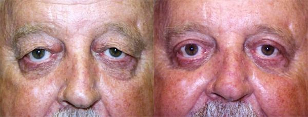 Eyelid Surgery Before & After Gallery - Patient 122405943 - Image 1