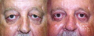 Eyelid Surgery Before & After Gallery - Patient 129771 - Image 1