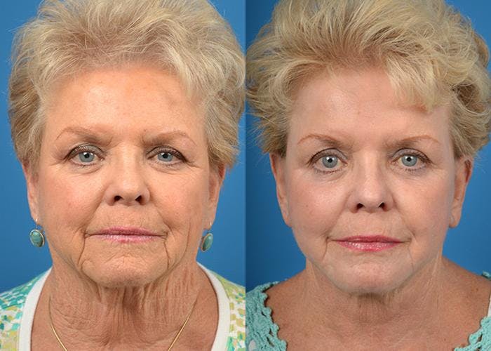 Facelift Before & After Gallery - Patient 122405945 - Image 1
