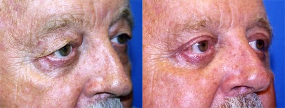 Eyelid Surgery Before & After Gallery - Patient 122405943 - Image 2
