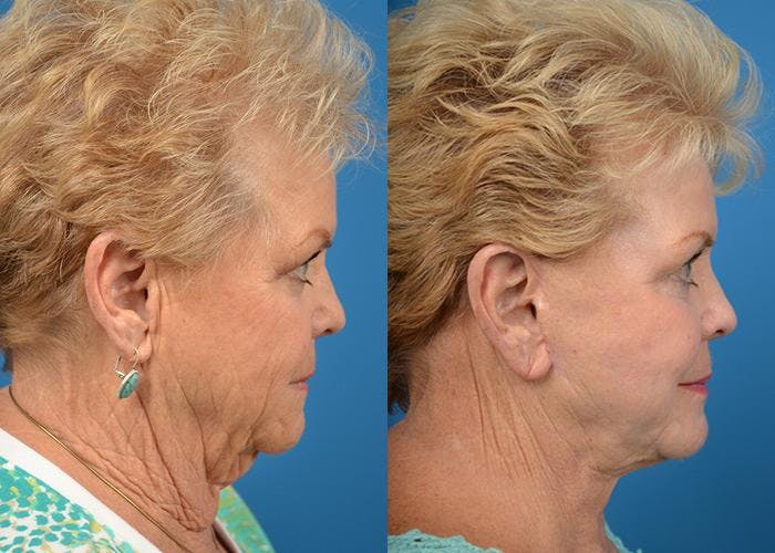 Facelift Before & After Gallery - Patient 122405945 - Image 2