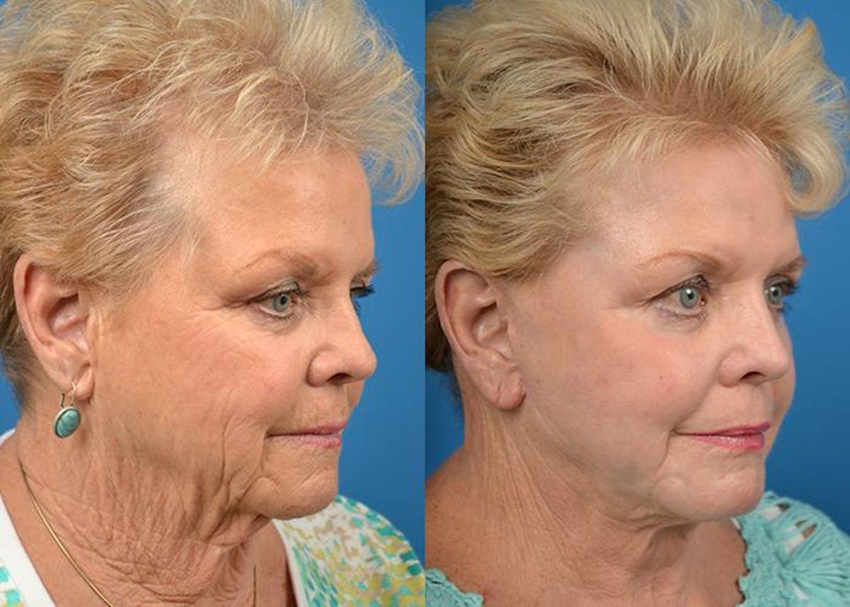 Facelift Before & After Gallery - Patient 122405945 - Image 3
