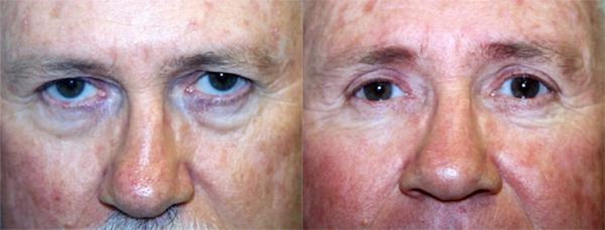 Eyelid Surgery Before & After Gallery - Patient 122405944 - Image 1