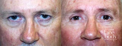 Eyelid Surgery Before & After Gallery - Patient 804377 - Image 1