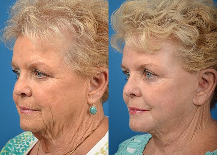 Facelift Before & After Gallery - Patient 122405945 - Image 4
