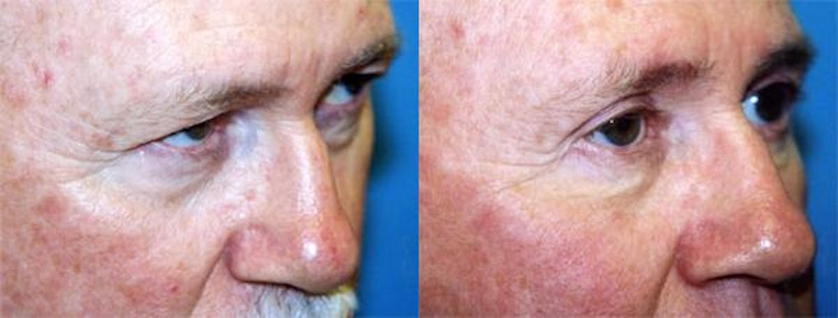 Eyelid Surgery Before & After Gallery - Patient 122405944 - Image 2