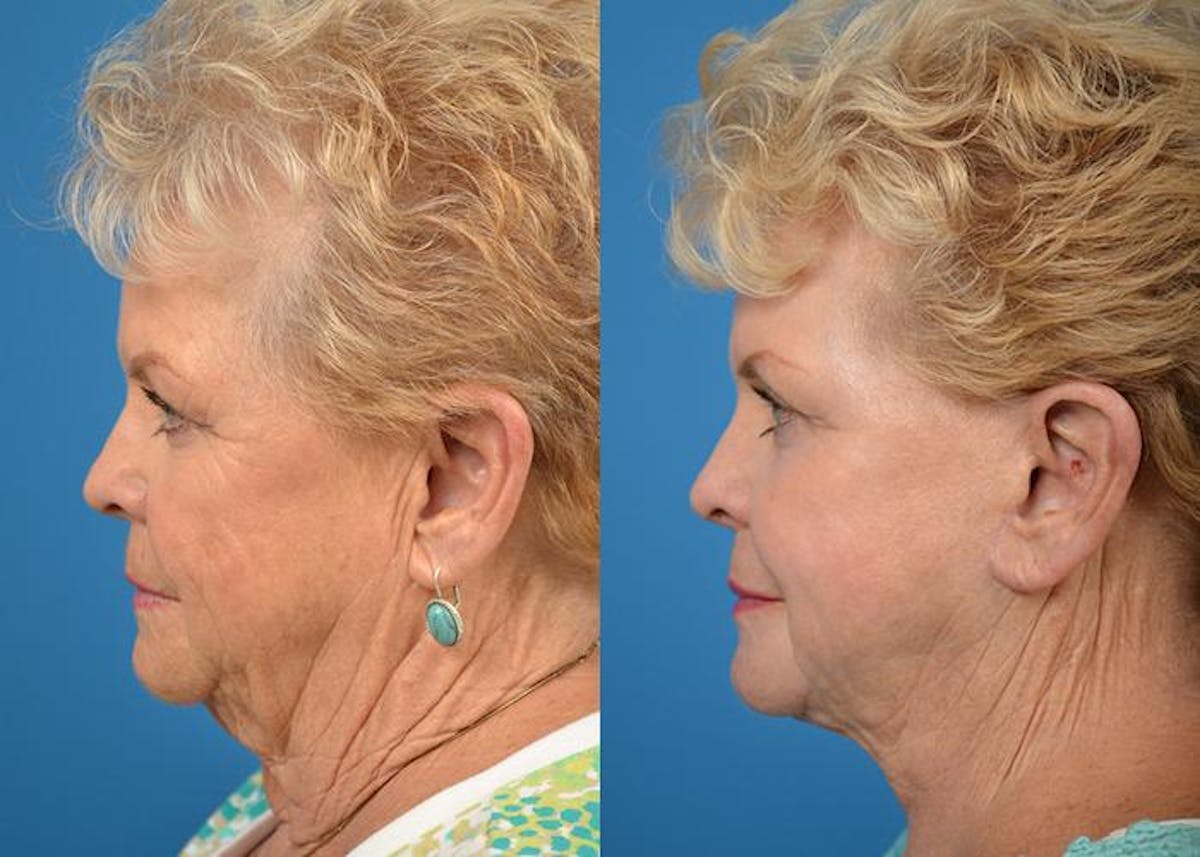 Facelift Before & After Gallery - Patient 122405945 - Image 5