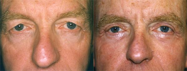 Eyelid Surgery Before & After Gallery - Patient 396339 - Image 1