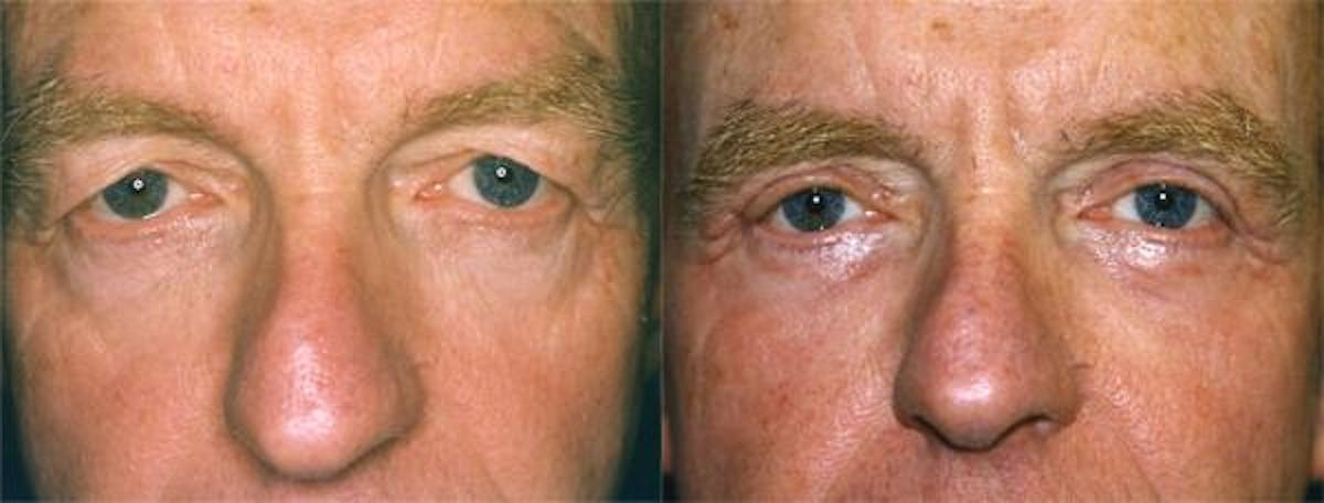 Eyelid Surgery Before & After Gallery - Patient 122405948 - Image 1