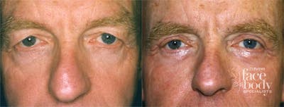 Eyelid Surgery Before & After Gallery - Patient 396339 - Image 1