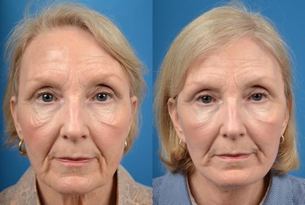 Facelift Before & After Gallery - Patient 122405950 - Image 1