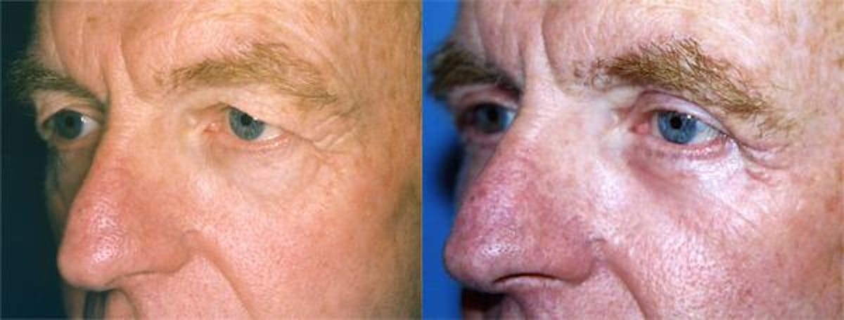 Eyelid Surgery Before & After Gallery - Patient 122405948 - Image 2