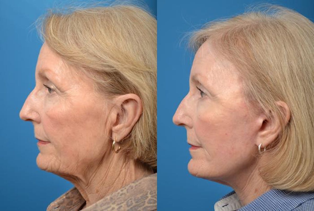 Facelift Before & After Gallery - Patient 122405950 - Image 2