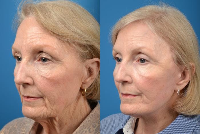 Facelift Before & After Gallery - Patient 122405950 - Image 3