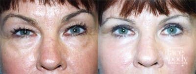 Eyelid Surgery Before & After Gallery - Patient 338013 - Image 1