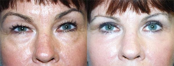 Eyelid Surgery Before & After Gallery - Patient 122405951 - Image 1