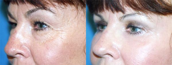 Eyelid Surgery Before & After Gallery - Patient 338013 - Image 2