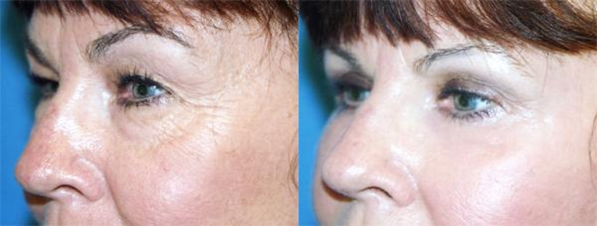 Eyelid Surgery Before & After Gallery - Patient 122405951 - Image 2