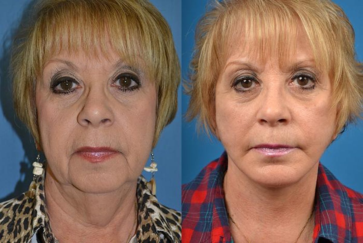Facelift Before & After Gallery - Patient 122405953 - Image 1