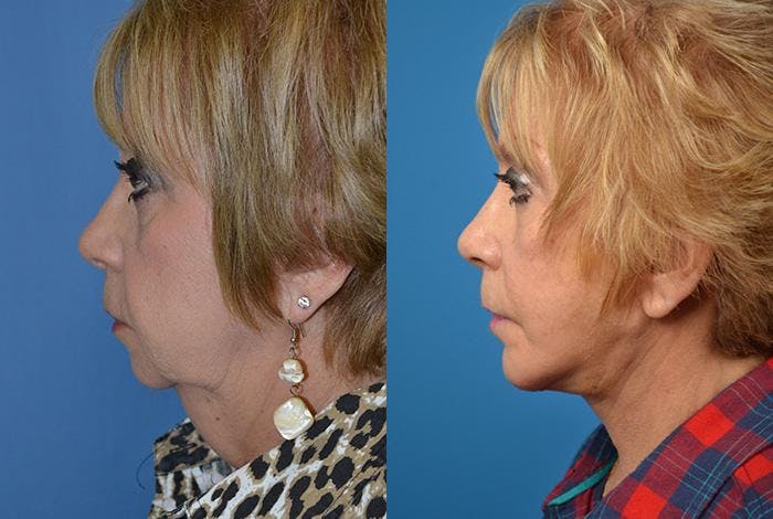 Facelift Before & After Gallery - Patient 122405953 - Image 2
