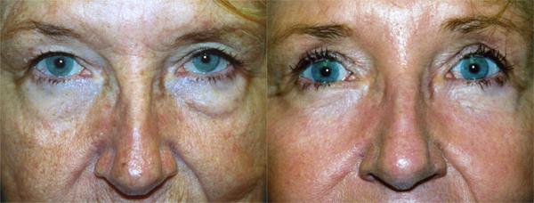 Eyelid Surgery Before & After Gallery - Patient 123256 - Image 1