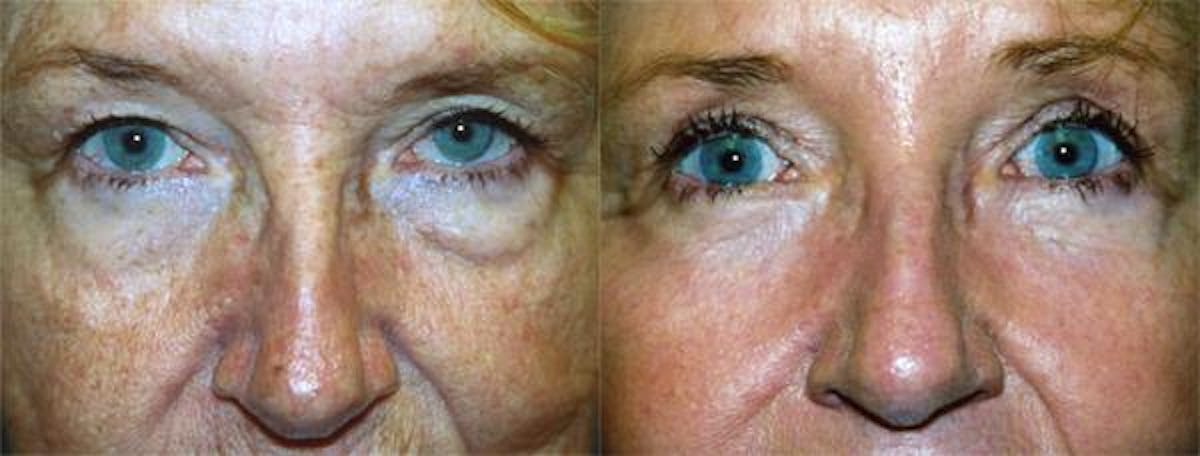 Eyelid Surgery Before & After Gallery - Patient 122405954 - Image 1
