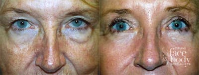 Eyelid Surgery Before & After Gallery - Patient 123256 - Image 1