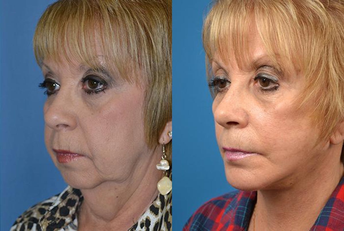 Facelift Before & After Gallery - Patient 122405953 - Image 3