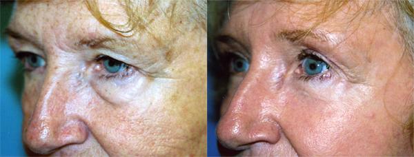Eyelid Surgery Before & After Gallery - Patient 123256 - Image 2