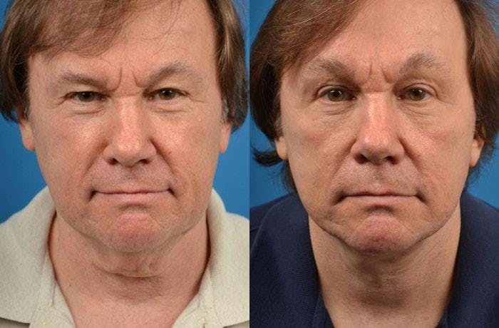 Facelift Before & After Gallery - Patient 122405959 - Image 1