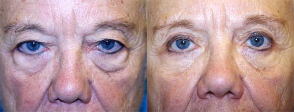 Eyelid Surgery Before & After Gallery - Patient 226704 - Image 1