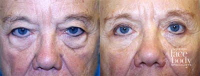 Eyelid Surgery Before & After Gallery - Patient 226704 - Image 1