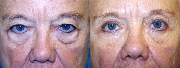 Eyelid Surgery Before & After Gallery - Patient 122405957 - Image 1