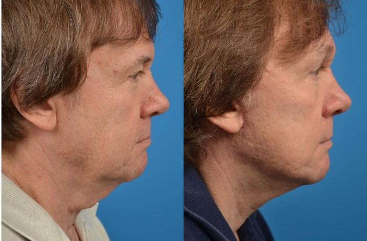 Facelift Before & After Gallery - Patient 122405959 - Image 2