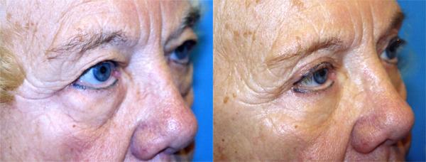 Eyelid Surgery Before & After Gallery - Patient 226704 - Image 2