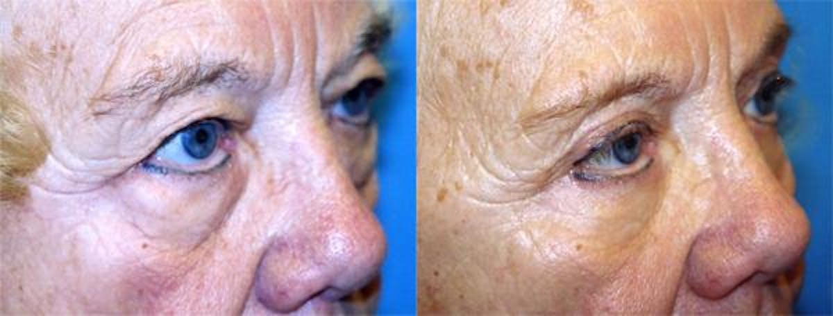 Eyelid Surgery Before & After Gallery - Patient 122405957 - Image 2