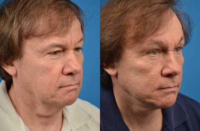 Facelift Before & After Gallery - Patient 122405959 - Image 3