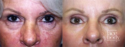Eyelid Surgery Before & After Gallery - Patient 181157 - Image 1