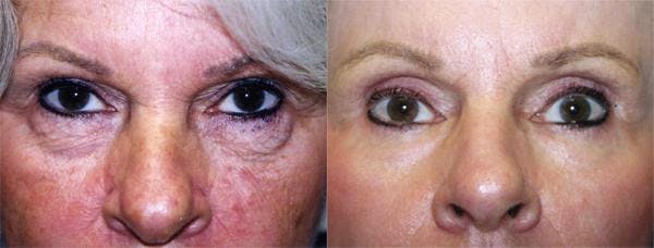 Eyelid Surgery Before & After Gallery - Patient 122405961 - Image 1