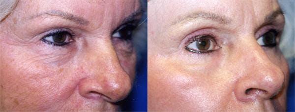 Eyelid Surgery Before & After Gallery - Patient 122405961 - Image 2